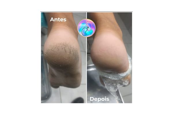 Foto de antes e depois do tratamento 37